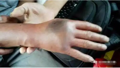 被小蛇咬了的伤口图片大全