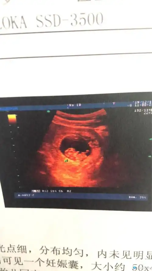 [试管婴儿]9周二超了,当看到你手脚长出