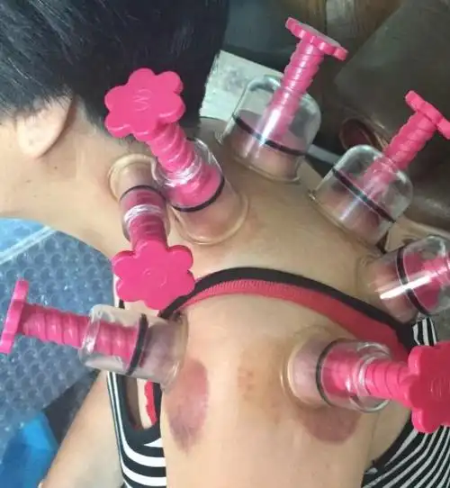 负压拔罐器治疗肩周炎