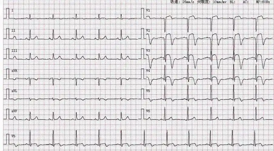 典型心电图:急性心肌梗死.没有基础也能一看就懂!_分析_检查_相关