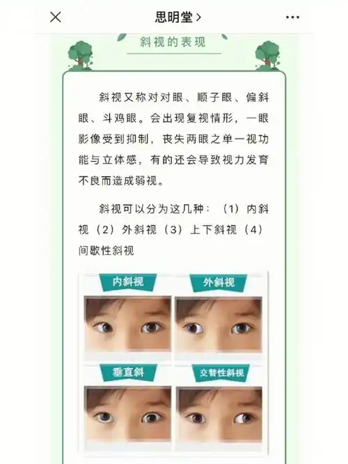 斜视是指两个眼睛没有办法同时看一个物体,大多是因为眼外肌发育过度