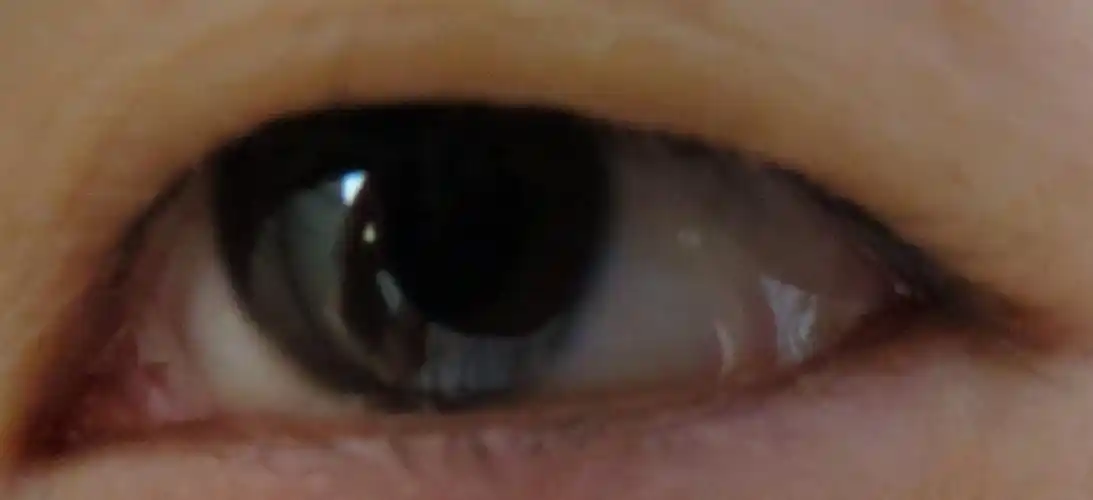 眨眼时,眼角眼白的最外面一层透明的东西像褶皱是什么症状?严重么?