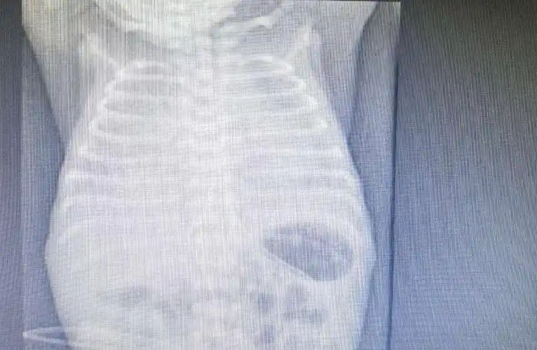 湖南一早产新生儿出现白肺,治疗3天后好转,专家紧急提醒!