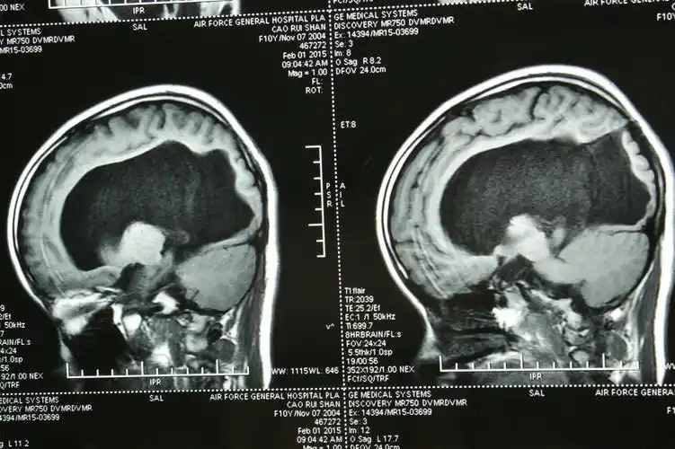 临床小儿多见头颅增大,囟门扩大,紧张饱满,颅缝开裂愈期不合,落日目