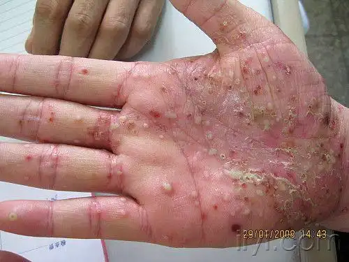 典型的掌跖脓疱病1例