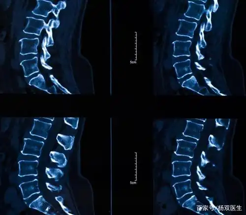 半椎体形成病因尚未完全明确,可能与胚胎发育异常有关,在脊柱发育期间