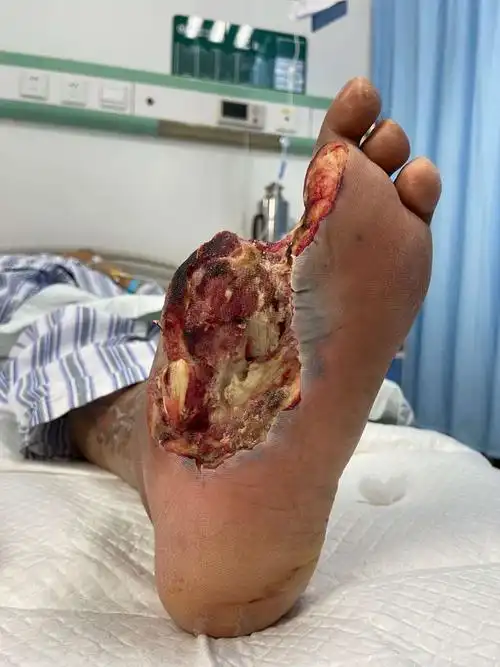 12,李连玉,创面多次清创截趾后感染较前明显好转,感染指标未进展