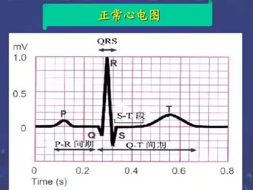 正常心电图