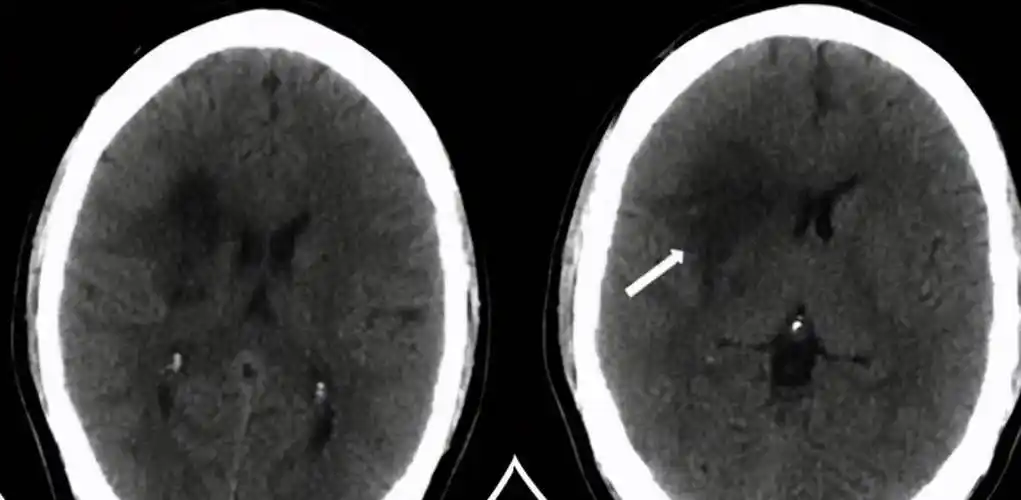 诱因不止有高血压这一个_动脉_血管_栓子