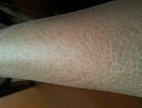 皮肤干燥鱼鳞腿脚跟干裂以为只是皮肤缺水错了病根其实在这里