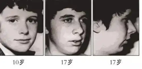 腺样体面容是腺样体肥大导致的最严重的症状之一.