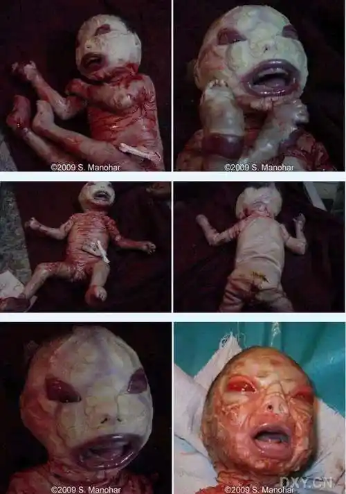 小儿hebra脂溢性鱼鳞病