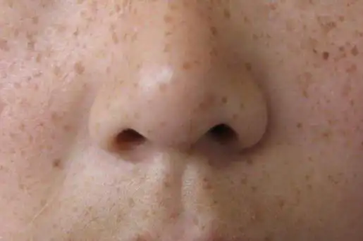 面部七种斑的图片