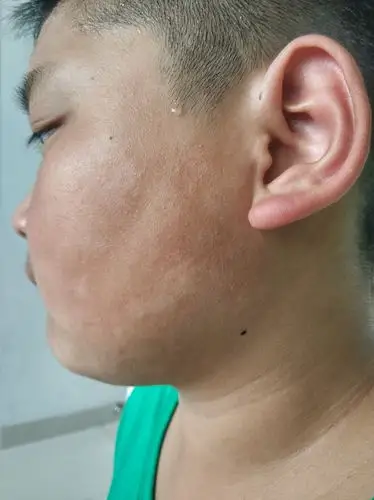 就会特别担心,是白癜风吗?其实,这是单纯糠疹,也叫白色糠疹.