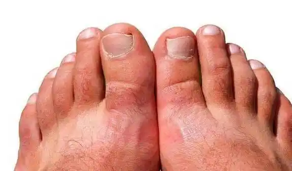 转告糖友患者:身体出现这4个表现,可能"烂脚"正悄悄靠近你!