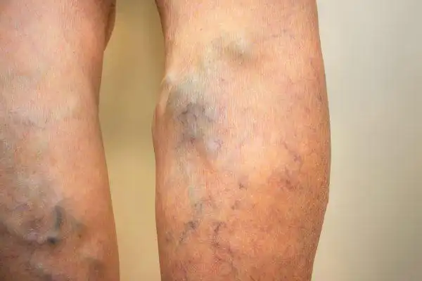 spider and varicose vein treatment clinic: introduc