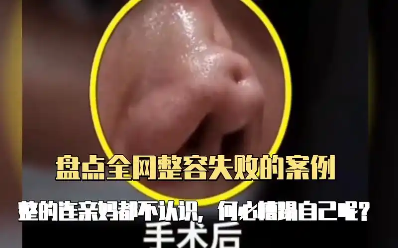 盘点全网整容失败的案例,整的连亲妈都不认识,何必糟蹋自己呢?