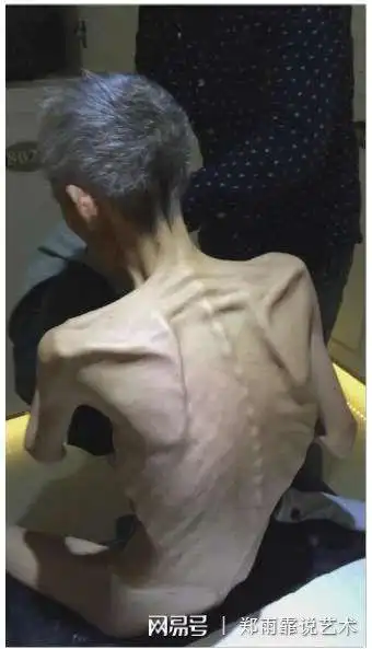 恶液质,是如何加速癌症病人死亡的?怎样才能有效应对?