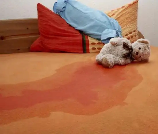 儿童尿床可持续到成年专家呼吁尽早治疗