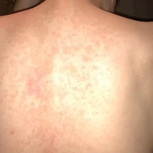 背上长满斑数月 这几天越来越明显和增多这是什么斑