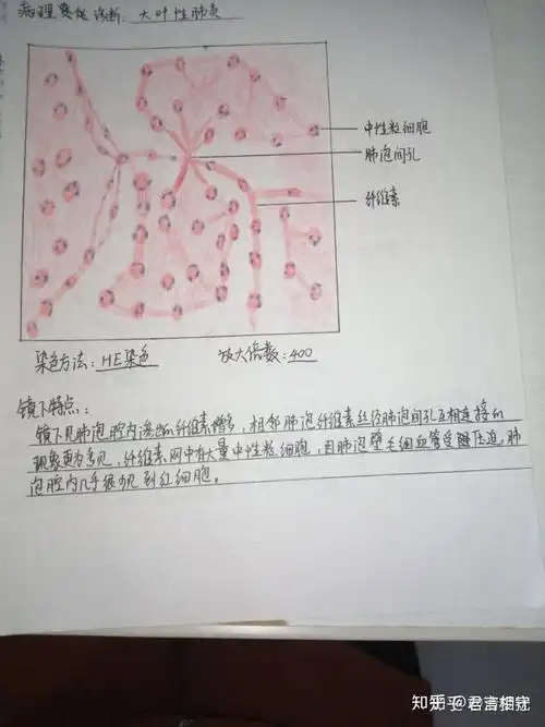 红蓝铅笔大叶性肺炎图怎么画