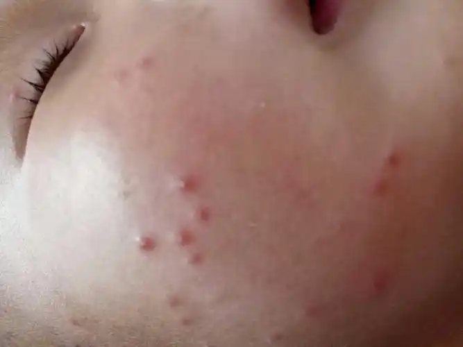 宝宝打了水痘疫苗,第二天就起了