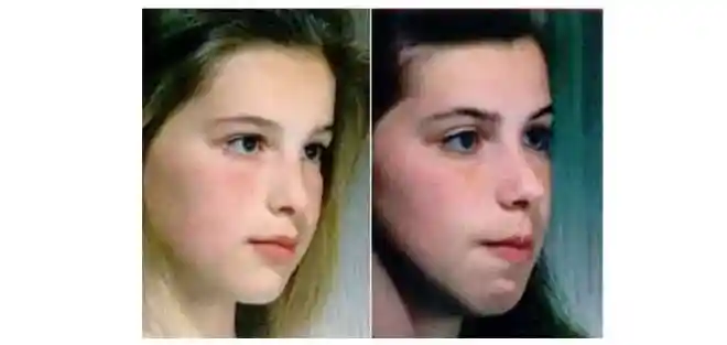 7岁娃腺样体大面容照片,父母要让孩子尽早治疗!