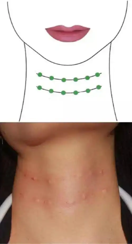 折纹显著,颈部充分伸展时折纹不消失,中度皮肤松弛,出现皮下脂肪垫; 4