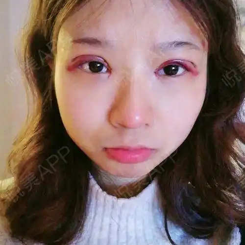 全切双眼皮术后3天_双眼皮术后3天_眼部整形术后3天_秋阿壮分享图片3