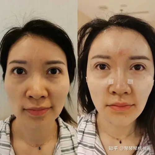 脂肪干细胞胶说是比脂肪填充更好,一般都不用二填就能达到效果.