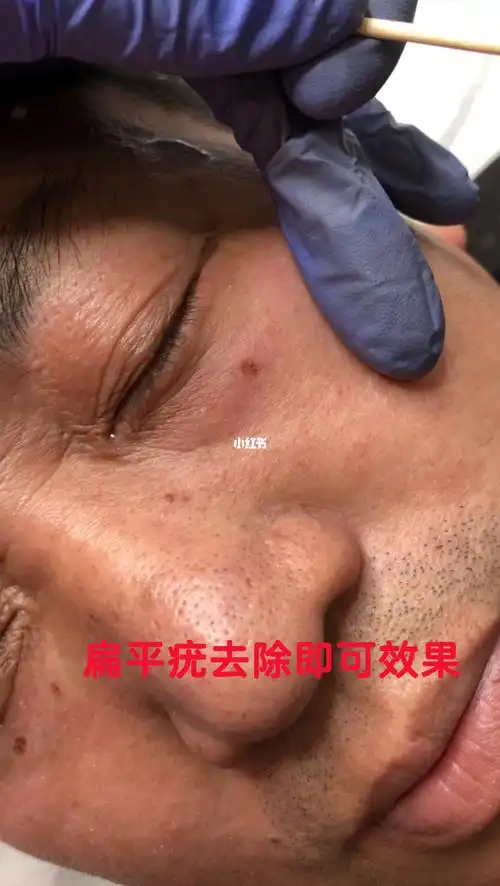 扁平疣终于点干净了