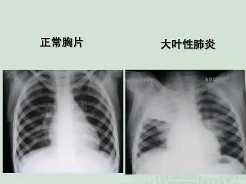 正常胸片 大叶性肺炎