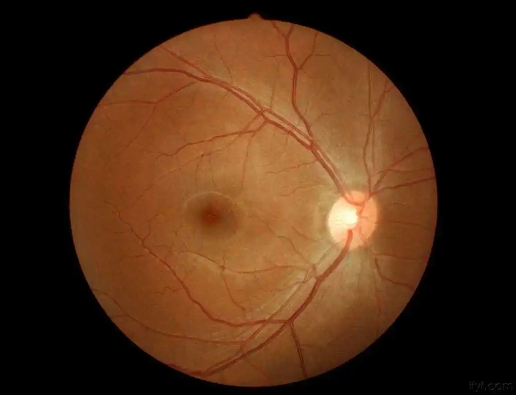 高度近视不仅影响眼睛外观,因眼轴延长,造成眼球凸出,还会发生眼球壁