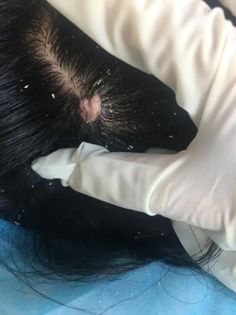 菜花疣 头皮部的疣,最早从外观上看可能就是皮赘样的小突起,但由于