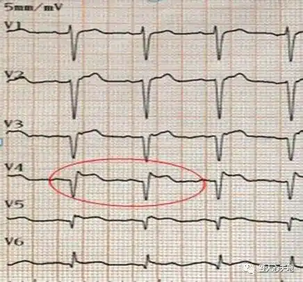 心电图急性心肌梗死图形