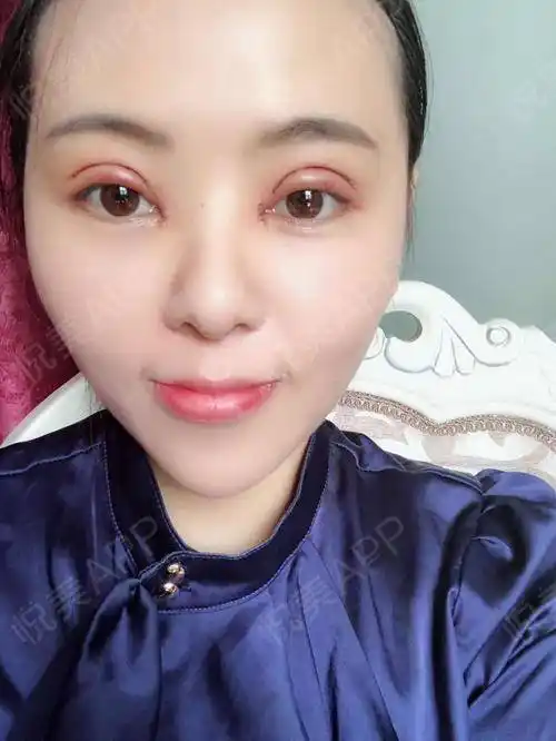 全切双眼皮术后1天_开眼角术后1天_双眼皮术后1天_眼部整形术后1天