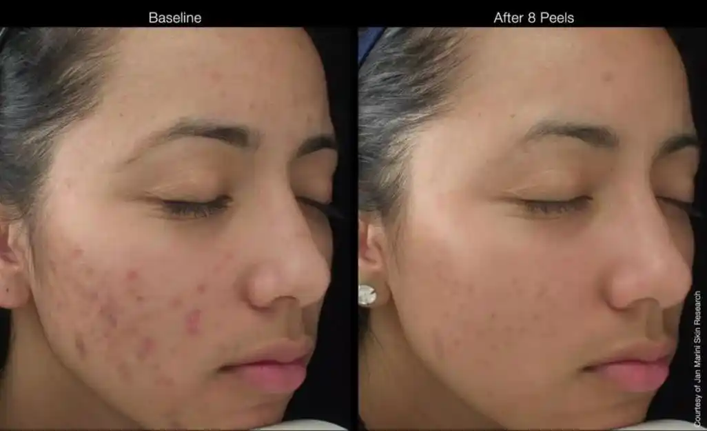 什么是果酸换肤 什么是果酸换肤?