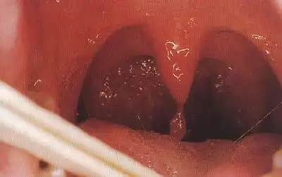 小舌头长了这个东西 我感觉像是不小心割破了小舌头