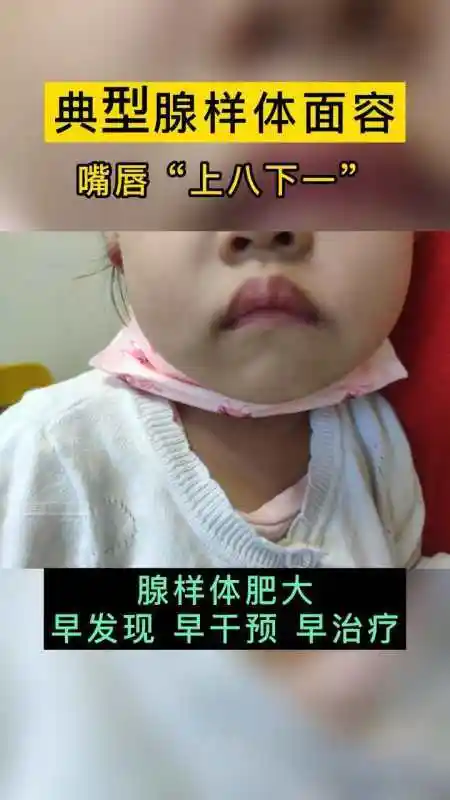 健康科普 医学科普 腺样体面容 涨知识