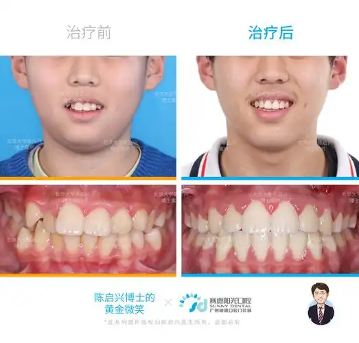 口呼吸腺样体面容矫正案例