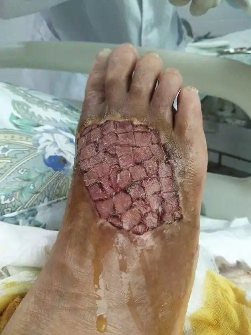 植皮术后7天,见到创面不再裸露,看见所植皮成活,患者露出开心的休容