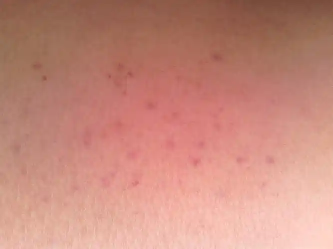 患者信息:女 21岁  病情描述(发病时间,主要症状等): 大腿上突然出现