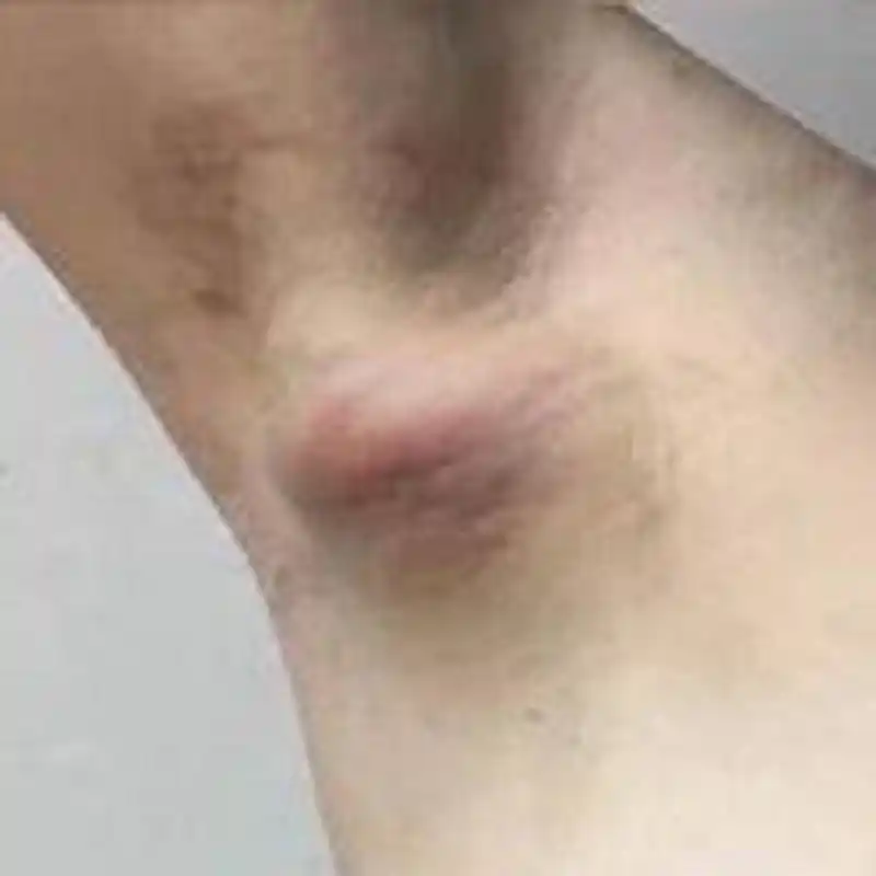 江女士洗澡时,摸到自己的腋下有一个大疙瘩,最近发现自己也瘦了,晚上