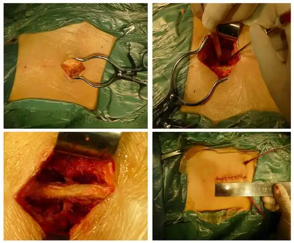 腰椎间盘突出症手术发展史:何谓微创手术?