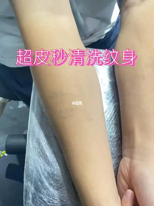 清洗纹身不留疤痕