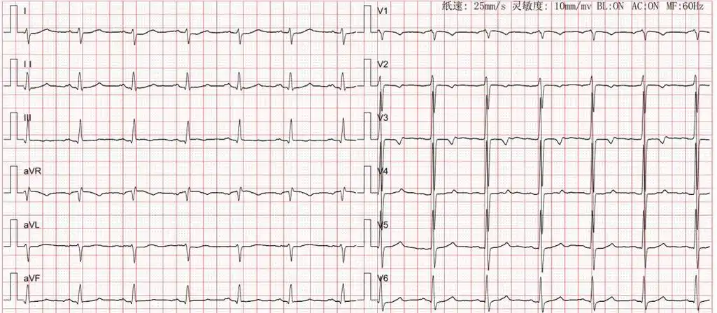 【看图说心】怎么看电轴右偏?