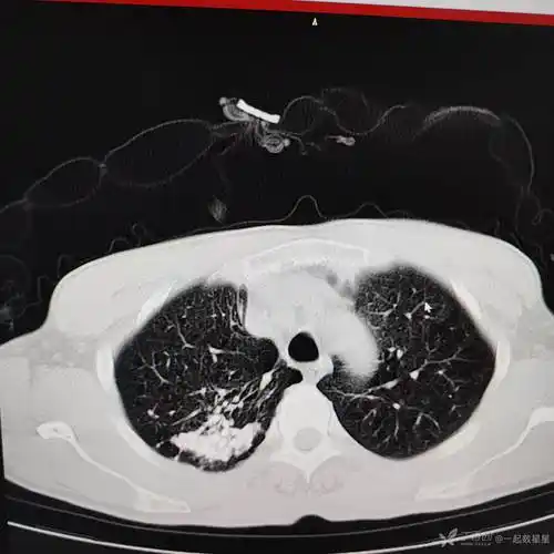 肺内多发钙化灶考虑什么