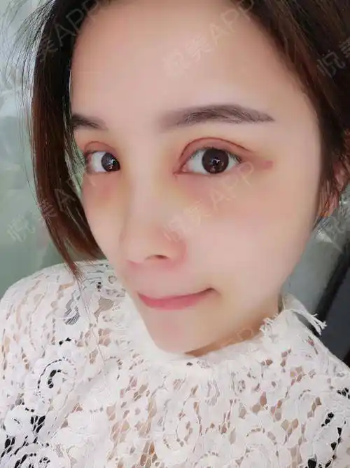 刚割完双眼皮,来和大家分享一下我的感受,从来没进过手术室的人,腿都