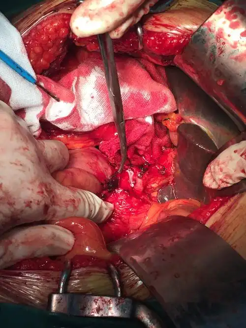 一见此图立刻就做超级大手术即胰十二指肠切除术 - 好大夫在线