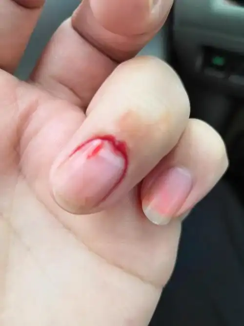 指甲盖上的肉长出硬块,碰到裂开或扯掉会流血,还会重复长,这是什么病?